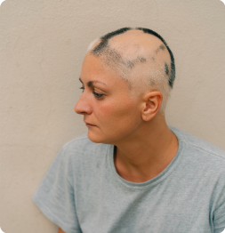 Alopecia Areata